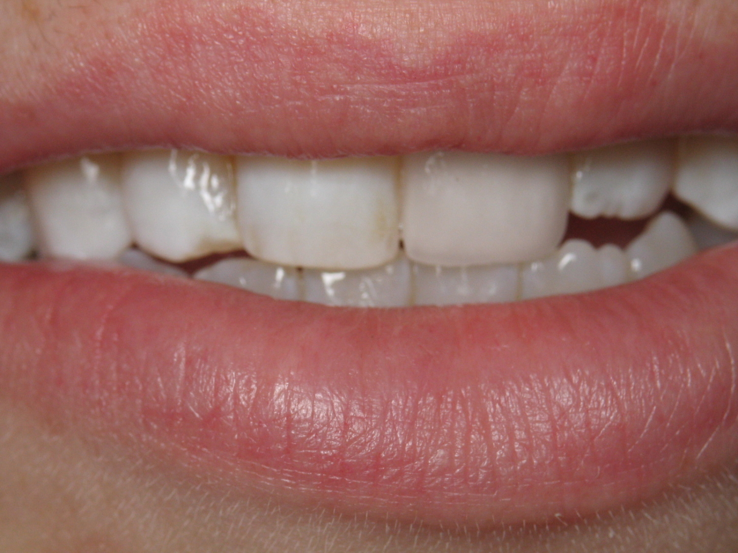 Dental Implants Gentle Dental Care, Dunfermline, Fife